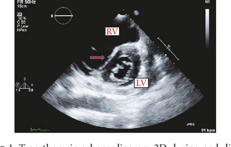 d shaped left ventricular dysfunction.